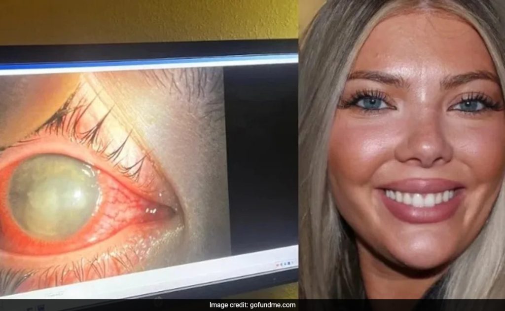 US Woman, 23, Goes Blind In One Eye After Swimming With Contact Lenses